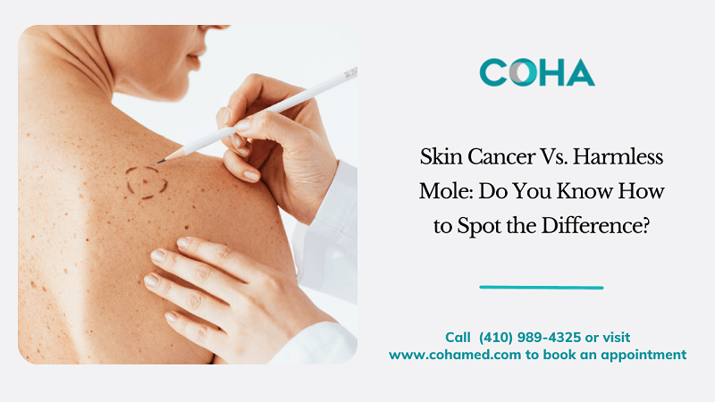 Skin Cancer Vs. Harmless Mole: Do You Know How to Spot the Difference?